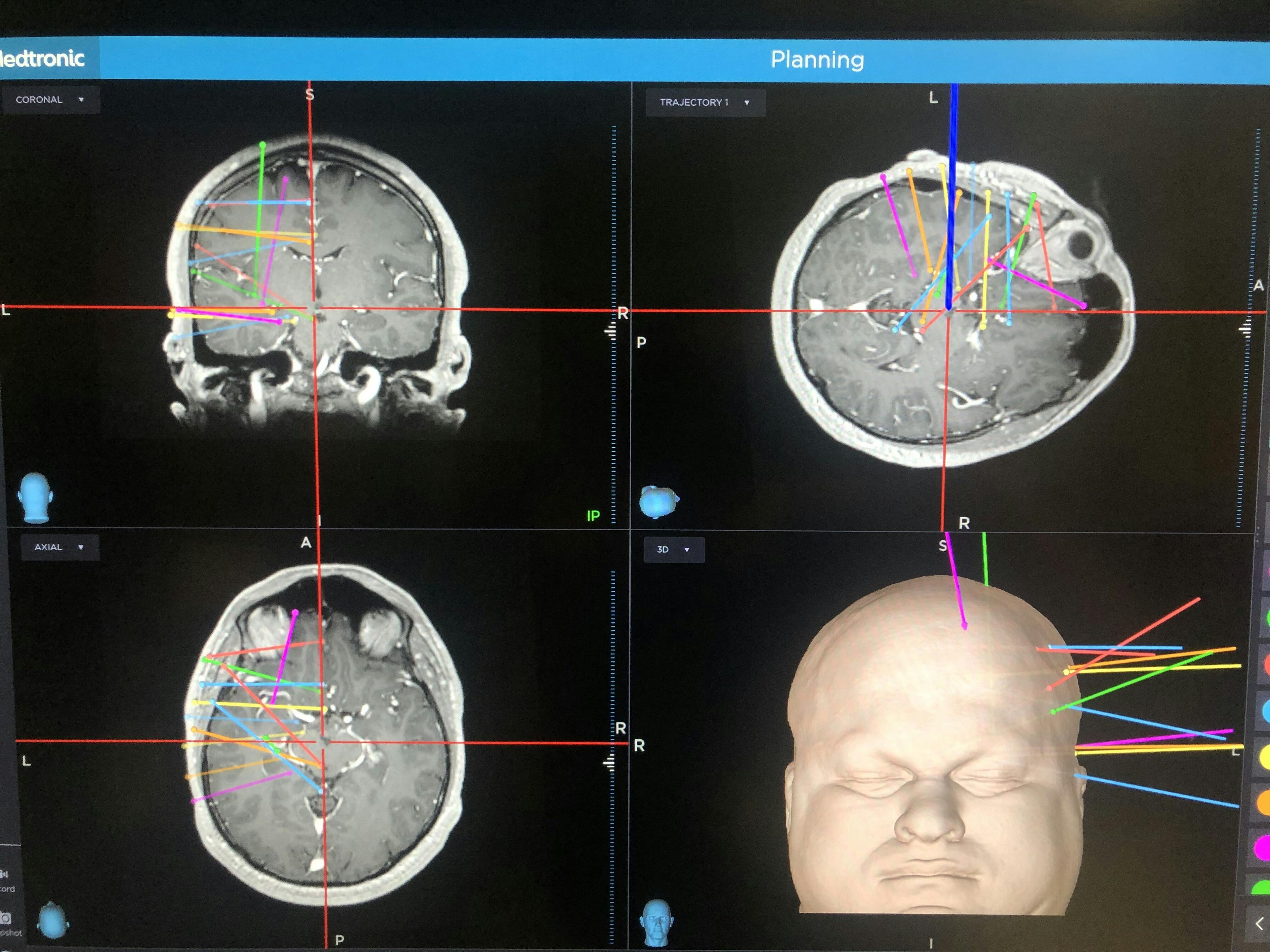 Computer screen showing brain scan results