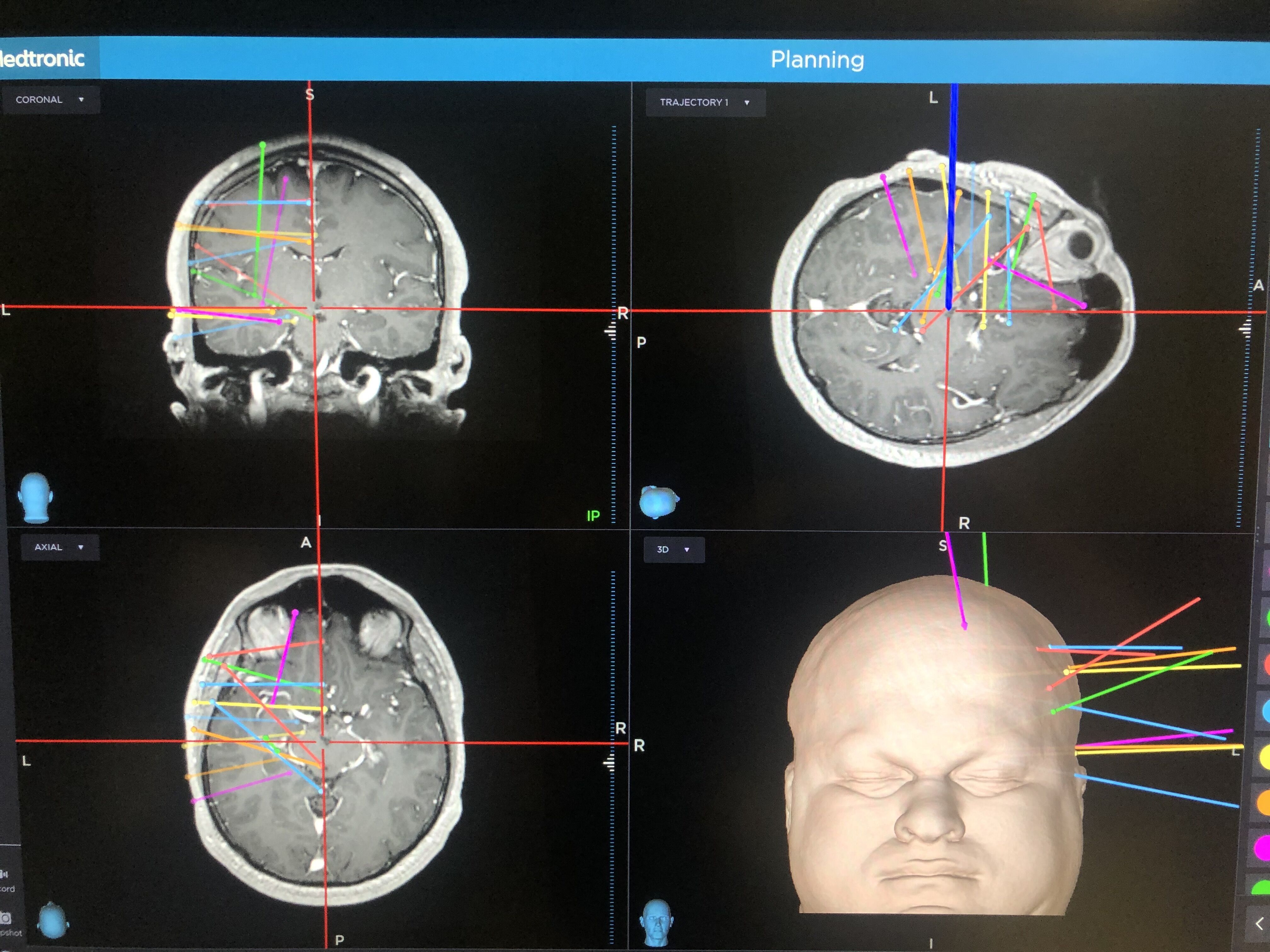Computer screen showing brain scan results